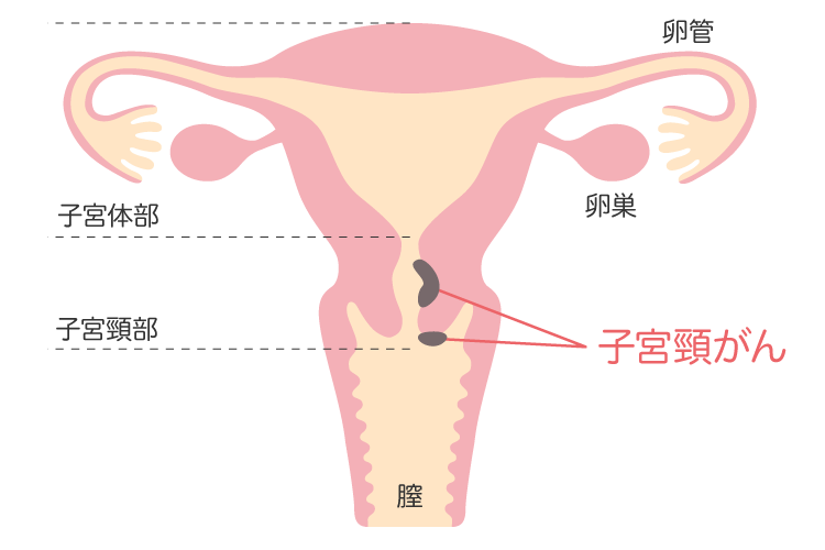 子宮頸がん