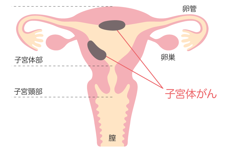 子宮体がん