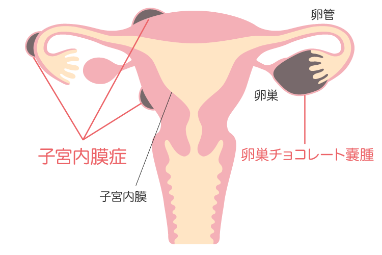 子宮内膜症について