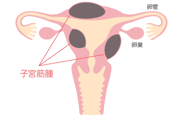 子宮筋腫について