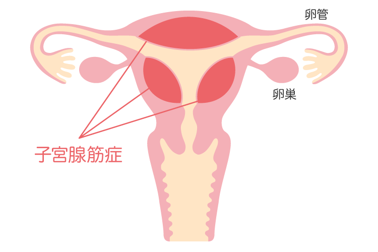 子宮腺筋症について