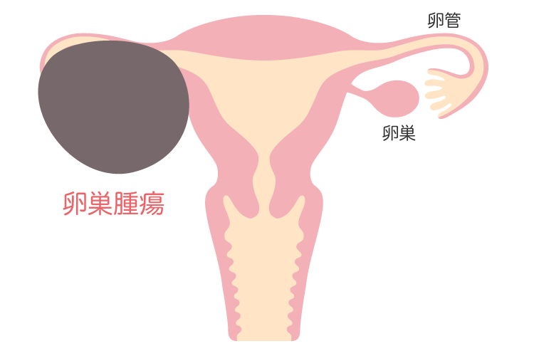 卵巣腫瘍について